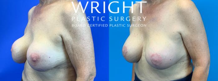 Before & After Breast Implant Exchange Case 271 Left Oblique View in Little Rock, Arkansas