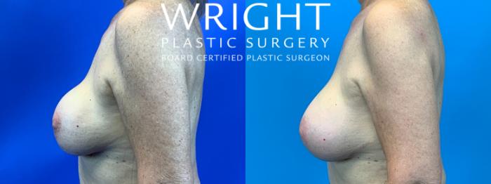 Before & After Breast Implant Exchange Case 271 Left Side View in Little Rock, Arkansas