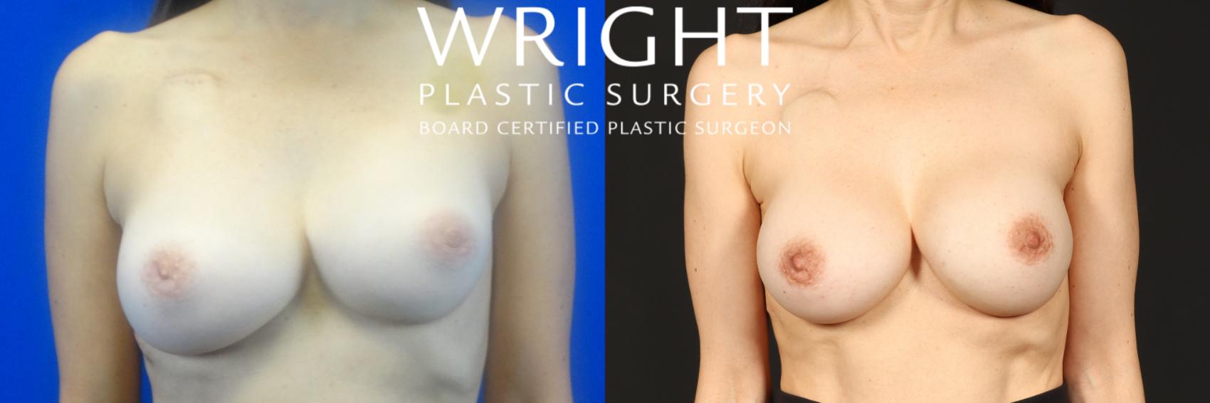 Before & After Breast Implant Exchange Case 273 Front View in Little Rock, Arkansas