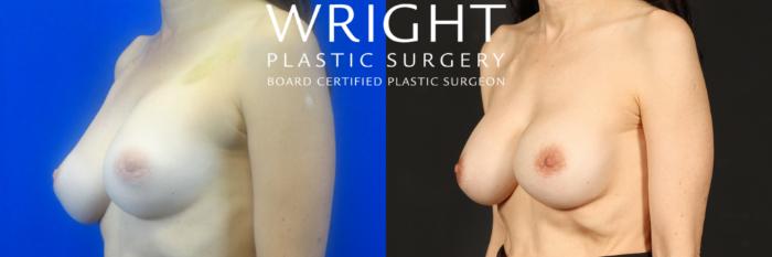 Before & After Breast Implant Exchange Case 273 Left Oblique View in Little Rock, Arkansas