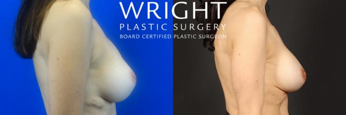 Before & After Breast Implant Exchange Case 273 Right Side View in Little Rock, Arkansas