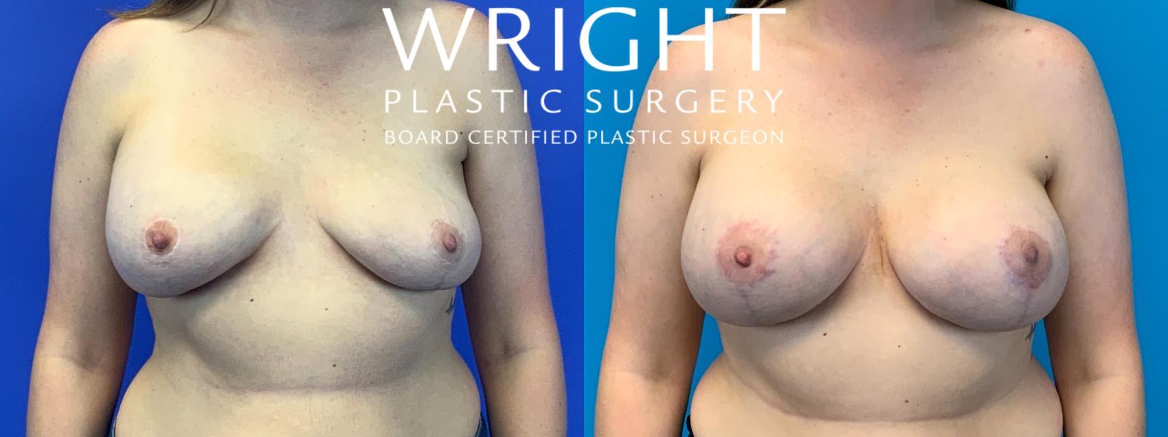 Before & After Breast Implant Exchange Case 278 Front View in Little Rock, Arkansas