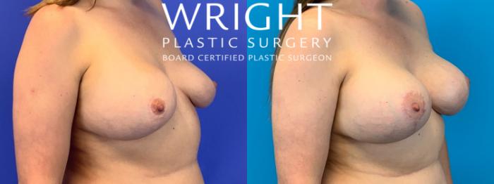 Before & After Breast Implant Exchange Case 278 Right Oblique View in Little Rock, Arkansas