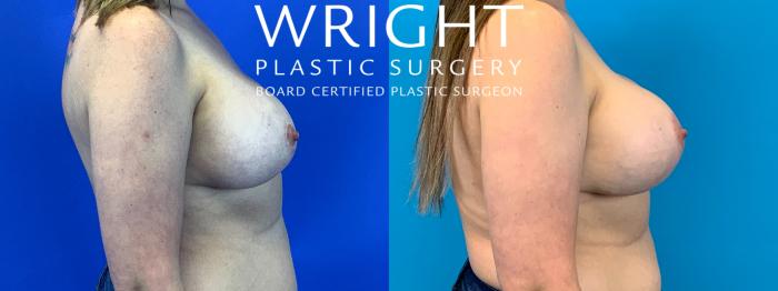 Before & After Breast Implant Exchange Case 278 Right Side View in Little Rock, Arkansas