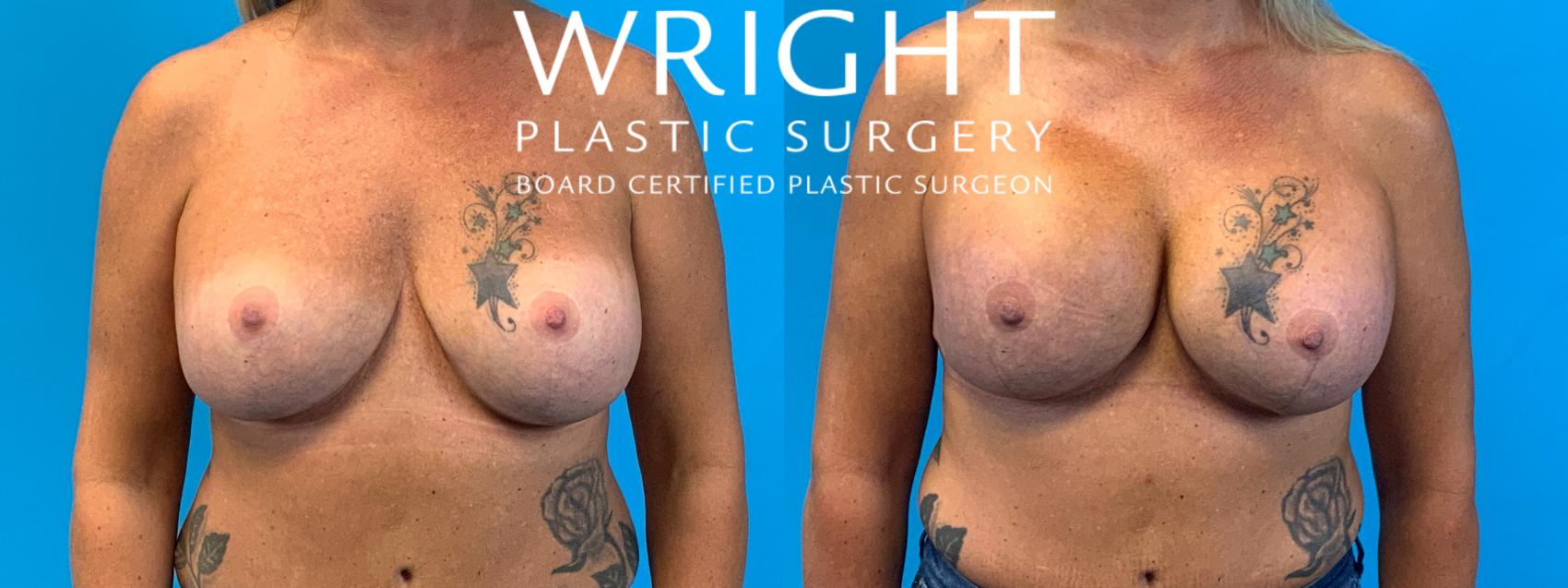 Before & After Breast Implant Exchange Case 324 Front View in Little Rock, Arkansas