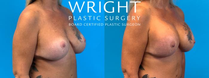 Before & After Breast Implant Exchange Case 324 Right Oblique View in Little Rock, Arkansas