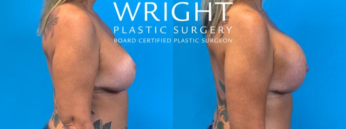 Before & After Breast Implant Exchange Case 324 Right Side View in Little Rock, Arkansas