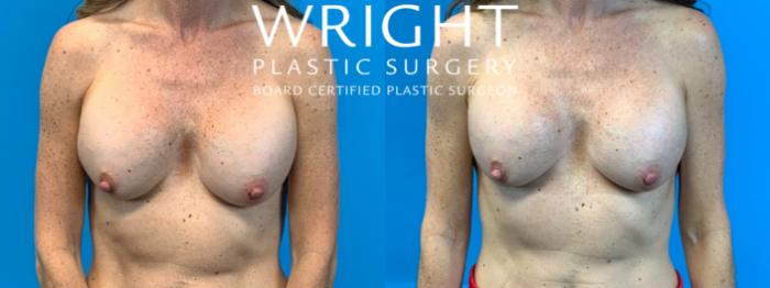 Before & After Breast Implant Exchange Case 334 Front View in Little Rock, Arkansas
