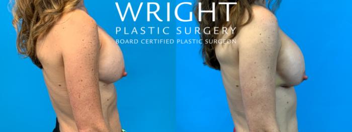 Before & After Breast Implant Exchange Case 334 Right Side View in Little Rock, Arkansas