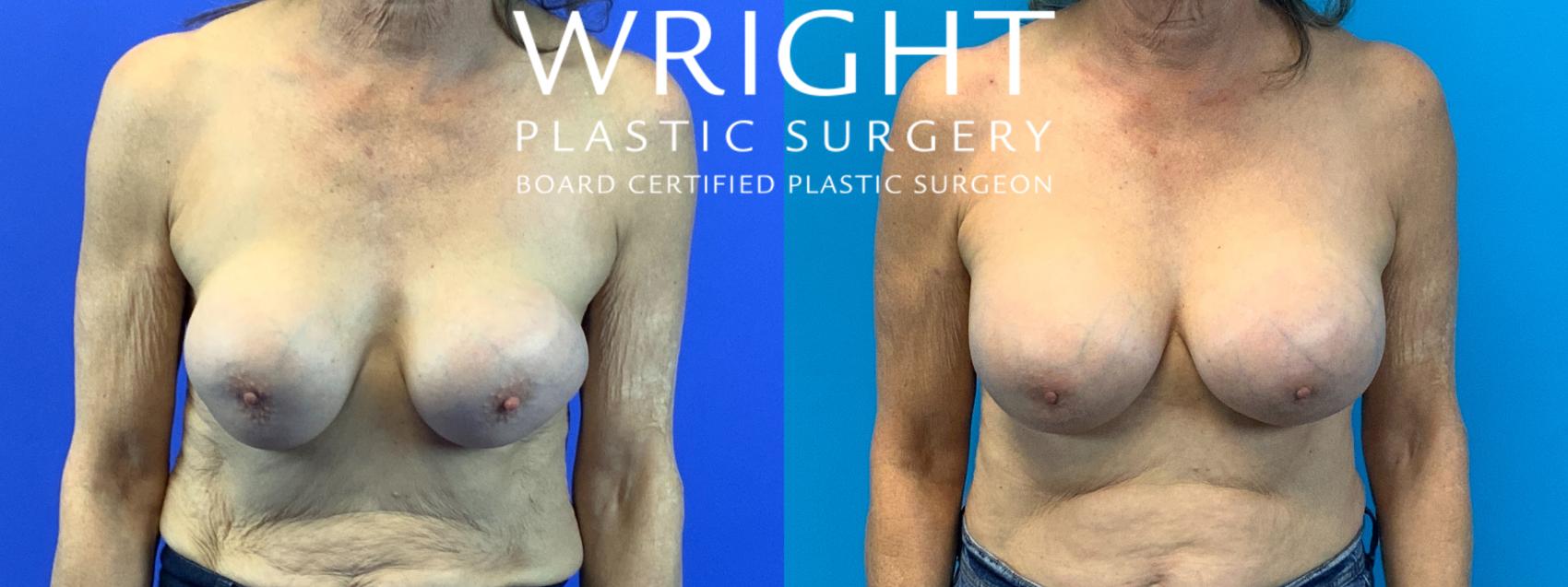 Before & After Breast Implant Exchange Case 345 Front View in Little Rock, Arkansas