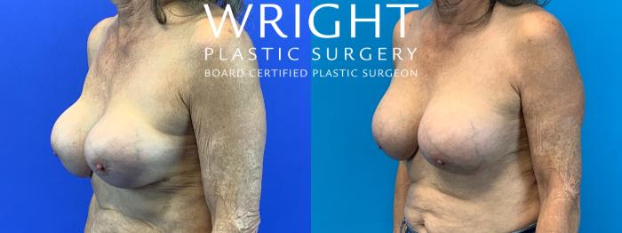 Before & After Breast Implant Exchange Case 345 Left Oblique View in Little Rock, Arkansas