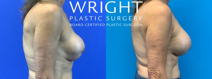 Before & After Breast Implant Exchange Case 345 Right Side View in Little Rock, Arkansas