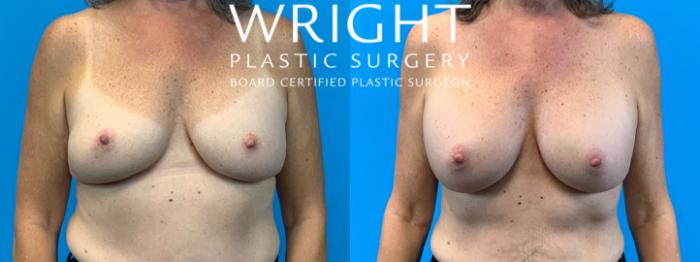 Before & After Breast Implant Exchange Case 369 Front View in Little Rock, Arkansas