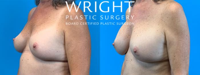 Before & After Breast Implant Exchange Case 369 Left Oblique View in Little Rock, Arkansas