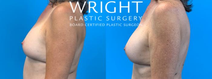 Before & After Breast Implant Exchange Case 369 Left Side View in Little Rock, Arkansas