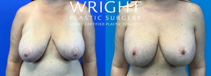 Before & After Breast Implant Exchange Case 370 Front View in Little Rock, Arkansas