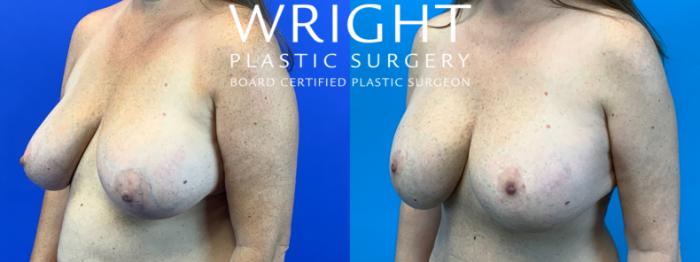 Before & After Breast Implant Exchange Case 370 Left Oblique View in Little Rock, Arkansas