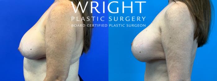 Before & After Breast Implant Exchange Case 370 Left Side View in Little Rock, Arkansas