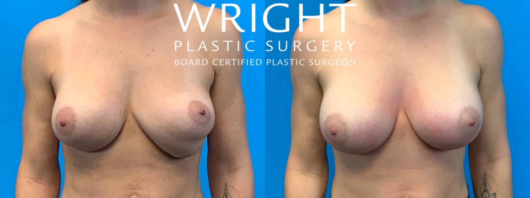 Before & After Breast Implant Exchange Case 374 Front View in Little Rock, Arkansas