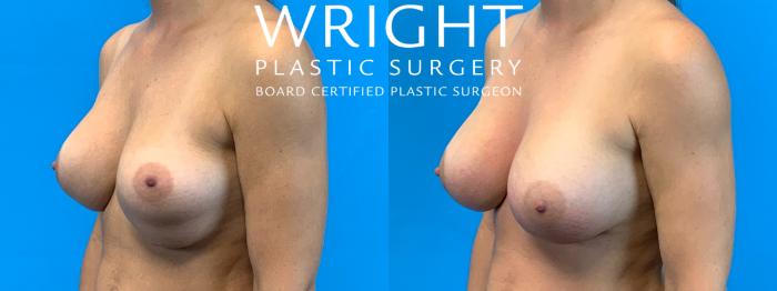 Before & After Breast Implant Exchange Case 374 Left Oblique View in Little Rock, Arkansas