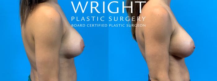 Before & After Breast Implant Exchange Case 374 Right Side View in Little Rock, Arkansas
