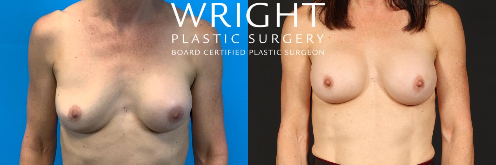 Before & After Breast Implant Exchange Case 377 Front View in Little Rock, Arkansas