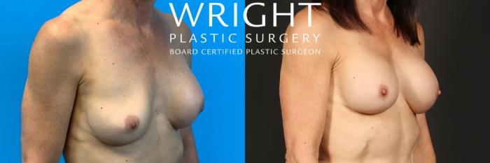 Before & After Breast Implant Exchange Case 377 Right Oblique View in Little Rock, Arkansas