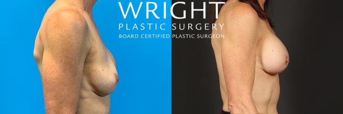 Before & After Breast Implant Exchange Case 377 Right Side View in Little Rock, Arkansas