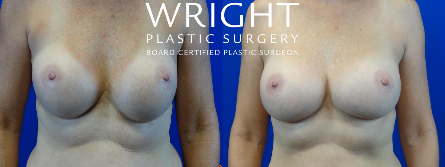 Before & After Breast Implant Exchange Case 40 Front View in Little Rock, Arkansas