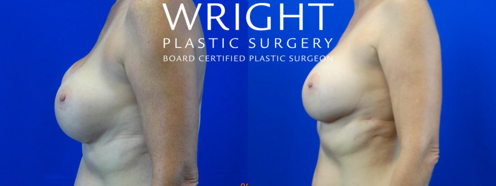 Before & After Breast Implant Exchange Case 40 Left Side View in Little Rock, Arkansas