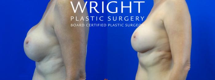 Before & After Breast Lift Case 40 Left Side View in Little Rock, Arkansas