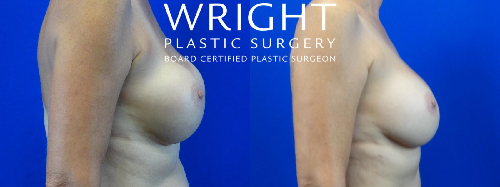 Before & After Breast Implant Exchange Case 40 Right Side View in Little Rock, Arkansas