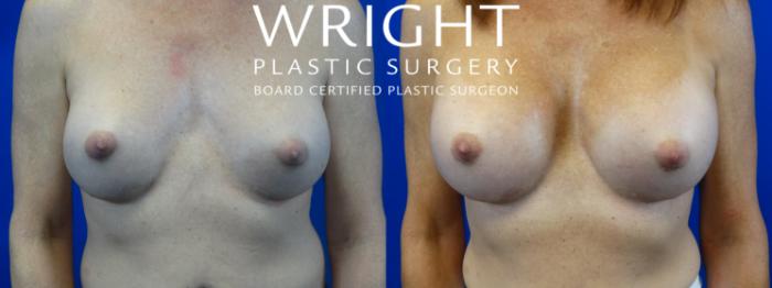 Before & After Breast Implant Exchange Case 41 Front View in Little Rock, Arkansas