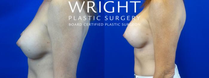 Before & After Breast Implant Exchange Case 41 Left Side View in Little Rock, Arkansas