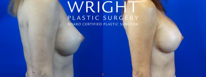 Before & After Breast Implant Exchange Case 41 Right Side View in Little Rock, Arkansas