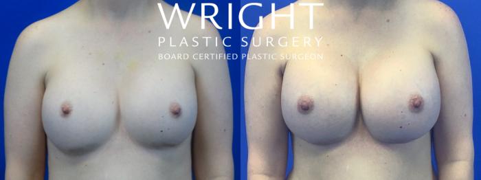 Before & After Breast Implant Exchange Case 42 Front View in Little Rock, Arkansas