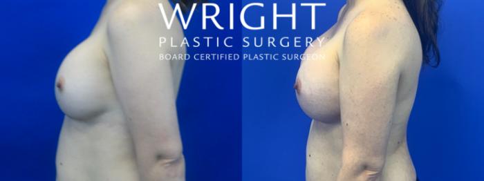 Before & After Breast Implant Exchange Case 42 Left Side View in Little Rock, Arkansas