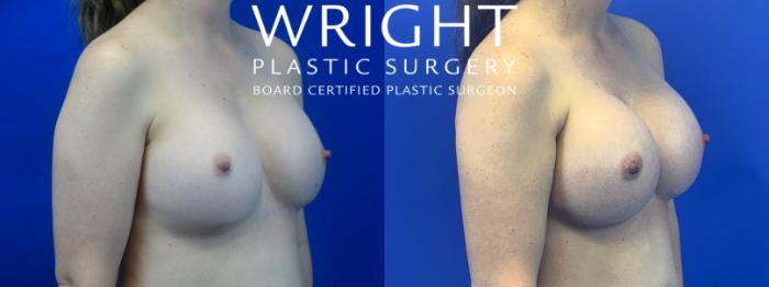Before & After Breast Implant Exchange Case 42 Right Oblique View in Little Rock, Arkansas