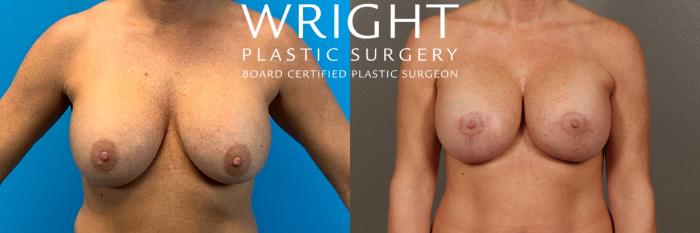 Before & After Breast Lift Case 421 Front View in Little Rock, Arkansas