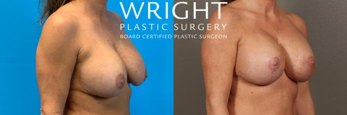 Before & After Breast Implant Exchange Case 421 Right Oblique View in Little Rock, Arkansas