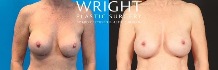 Before & After Breast Implant Exchange Case 458 Front View in Little Rock, Arkansas