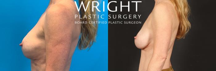 Before & After Breast Implant Exchange Case 458 Left Side View in Little Rock, Arkansas