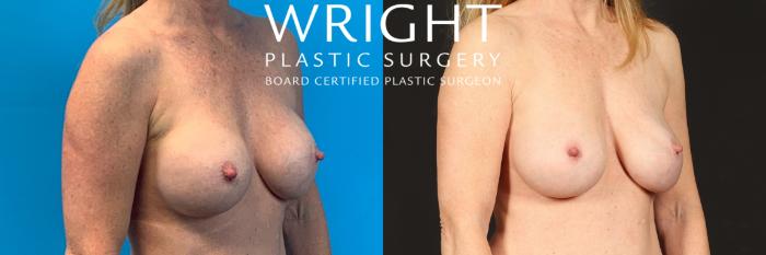 Before & After Breast Implant Exchange Case 458 Right Oblique View in Little Rock, Arkansas