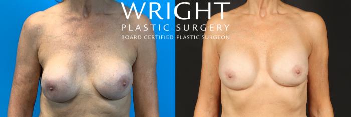 Before & After Breast Implant Exchange Case 463 Front View in Little Rock, Arkansas