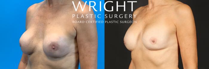 Before & After Breast Implant Exchange Case 463 Left Oblique View in Little Rock, Arkansas