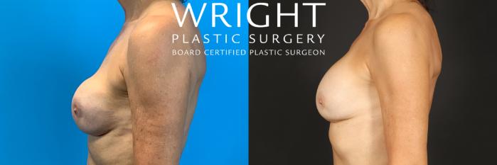 Before & After Breast Implant Exchange Case 463 Left Side View in Little Rock, Arkansas
