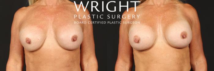 Before & After Breast Implant Exchange Case 521 Front View in Little Rock, Arkansas