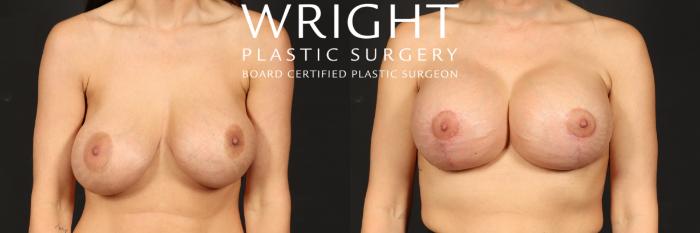 Before & After Breast Implant Exchange Case 547 Front View in Little Rock, Arkansas