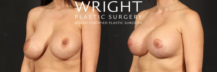 Before & After Breast Implant Exchange Case 547 Left Oblique View in Little Rock, Arkansas