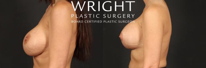 Before & After Breast Implant Exchange Case 547 Left Side View in Little Rock, Arkansas